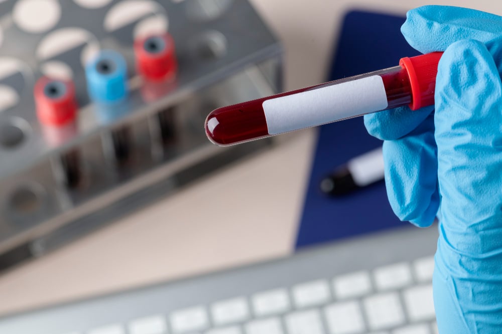 What is microdeletion in the NIPT test?