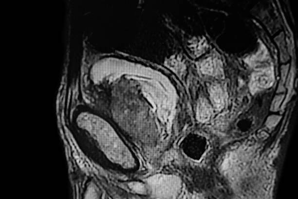 Pelvic MRI