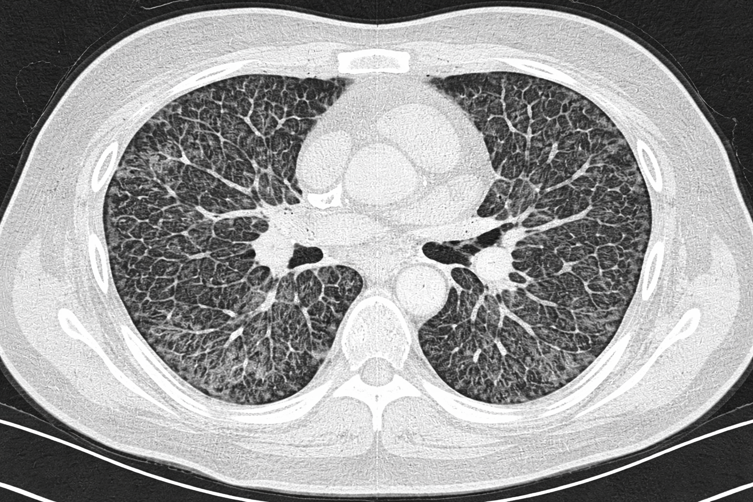 HRCT Cost, Risks, and Radiation: What You Should Know Before Booking